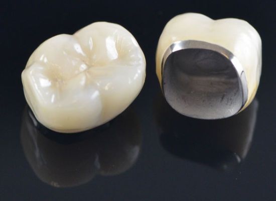 All-Metal Crowns