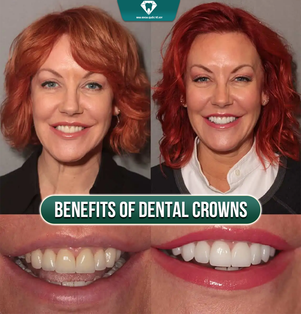 Benefits of dental crowns