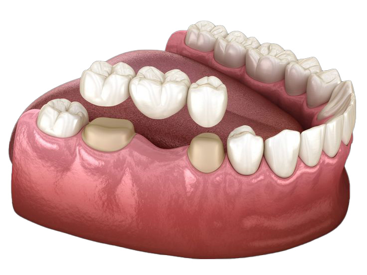 Dental Crowns