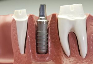Implant Post