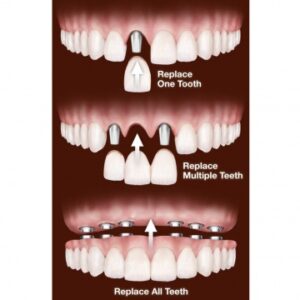 Number of teeth to be replaced