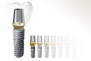 Outstanding Advantages of Hiossen Implant Technology