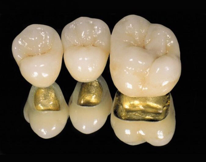 Porcelain-Fused-to-Metal Crowns