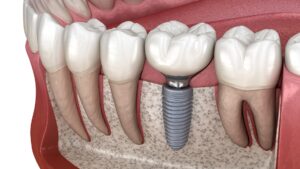 What is a Dental Implant