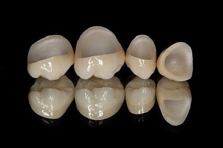All-Ceramic or Porcelain Crowns