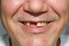 Causes of Tooth Loss