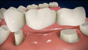 Cost of Replacing Tooth #6 with a Dental Bridge