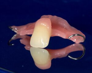 Cost of Replacing Tooth #6 with a Removable Partial Denture