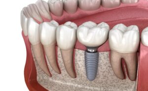 Dental Implants replace teeth lost years ago