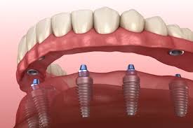 Implant-Supported Dentures without a Bar Attachment