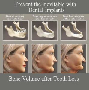 Not replacing a missing permanent tooth cause Bone Loss and Premature Aging