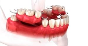 Removable Dentures