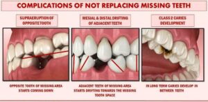 Severe Impact on Chewing Function