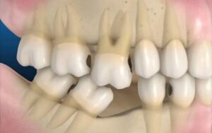 The Consequences of Losing Tooth #6