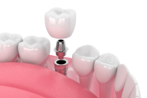 The cost of tooth number 6 replacement with Dental Implants