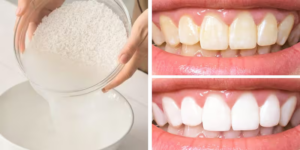 Is Rice Water Teeth Whitening Suitable for You