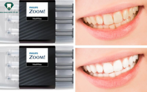 The Remarkable Advantages of Philips Zoom