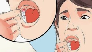 The Undeniable Importance of Post-Wisdom Tooth Extraction Care