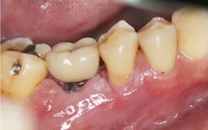 Damage to Surrounding Tissues
