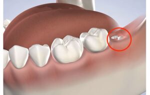 Does Extracting a Straight Wisdom Tooth Hurt?