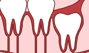 How Are Straight Wisdom Teeth Different?