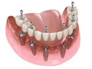 Implant all on 6 helps shorten treatment time
