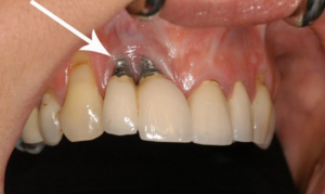 Infection Around the Implant Site