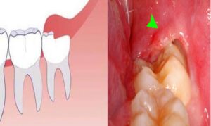 Is It Always Necessary to Extract a Straight Growing Wisdom Tooth?