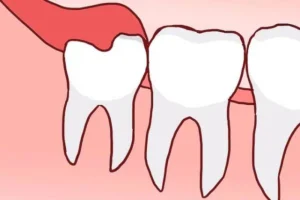 Is a Straight Growing Wisdom Tooth Harmful to Oral Health?