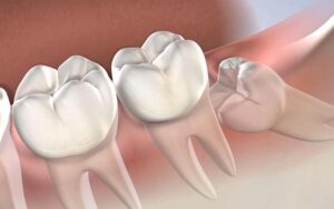 Jaw Misalignment and Tooth Crowding