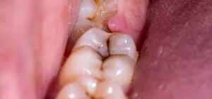 Oral Diseases