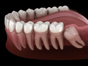 When Do Wisdom Teeth Typically Emerge?
