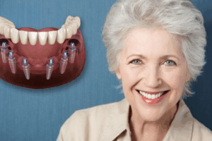 Restoration of Over 90% Chewing Function