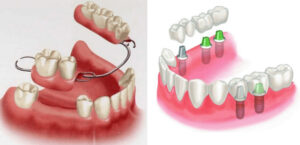 Should You Choose Removable Dentures or Fixed Dental Restorations?