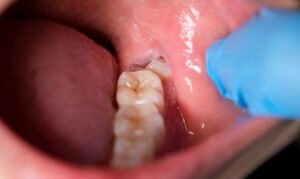 Signs of wisdom teeth growth Lower