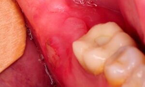 Swelling Around the Gums