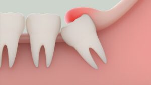 Swollen, Inflamed Gums