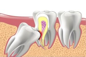 The Hidden Dangers of Impacted Wisdom Teeth