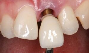 The risks of opting for cheap dental implants is that the implant will be rejected by the body