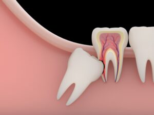 What Are Impacted Wisdom Teeth?