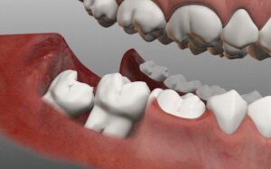 What Are Wisdom Teeth and What Is Their Function?