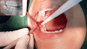 What Happens If You Don’t Remove Wisdom Teeth?