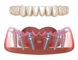 What is the All-on-6 Dental Implant Method?