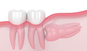What’s the Best Way to Treat Impacted Wisdom Teeth?