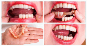 When Should You Opt for Removable Dentures?