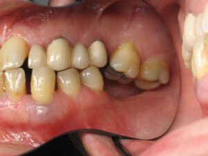 Bone loss and gum recession