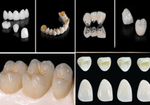 Common Types of Dental Bridges
