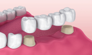 Dental Bridges