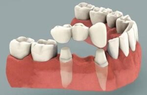 Dental Crown With Bridges