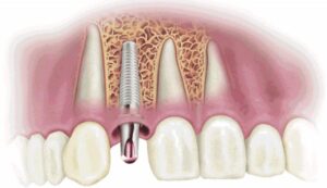 Dental Implant Not Suitable for Everyone